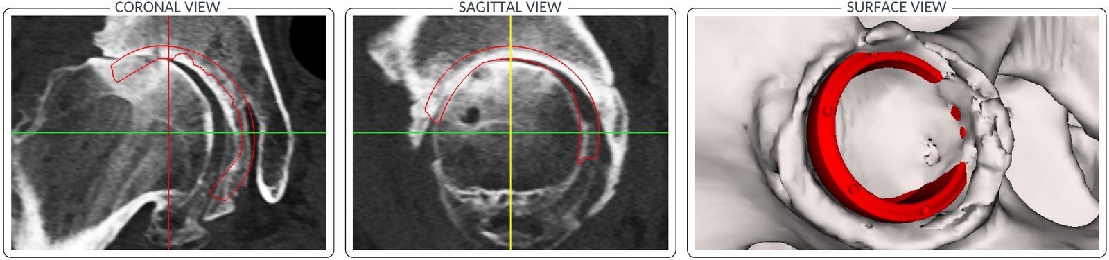 Positionnement de la cupule sur le scanner, de face, de profil et en vue 3D